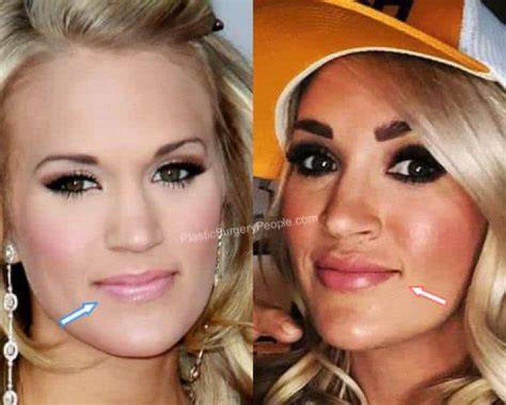 Did Carrie Underwood Get Lip Fillers?