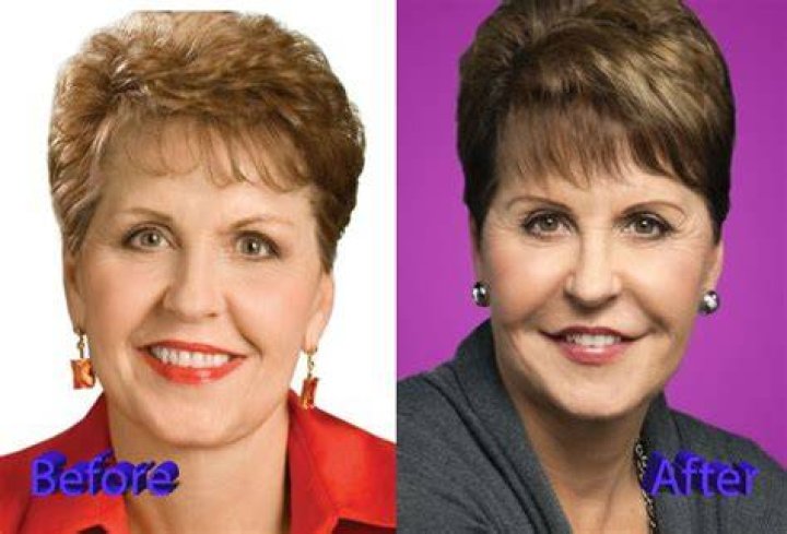 Joyce Meyer lips Surgery VIP